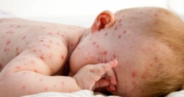 Gyermekek milliói fogják megkapni a bárányhimlő elleni védőoltást Nagy-Britanniában 2026-tól