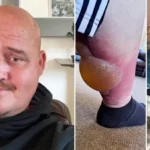 Azt hitte tettek valamit a piájába, aztán kiderült, hogy Anglia legmérgesebb pókja harapta meg – ilyen a hamis özvegy csípése