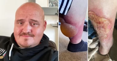 Azt hitte tettek valamit a piájába, aztán kiderült, hogy Anglia legmérgesebb pókja harapta meg - ilyen a hamis özvegy csípése