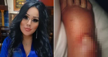 Majdnem amputálni kellett egy nő lábfejét Angliában, miután megcsípte az ország egyik legveszélyesebb pókja