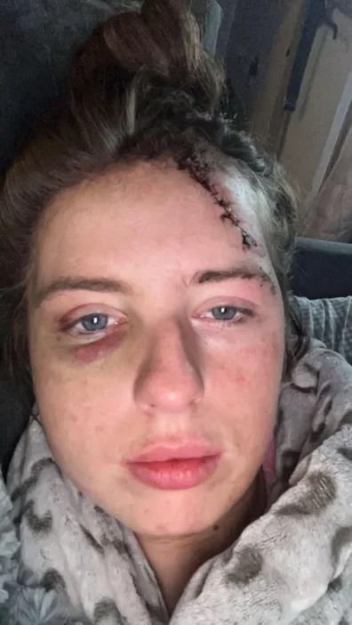Egy fiatal brit nő arra sem emlékezett, hogy miért csupa zúzódás és miért van hatalmas seb a fején – aztán az ápolónő csak 4 szót mondott neki 6