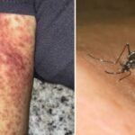 Több, mint duplájára emelkedett a chikungunya vírussal fertőzöttek száma az Egyesült Királyságban – amihez egy szúnyogcsípés is elég