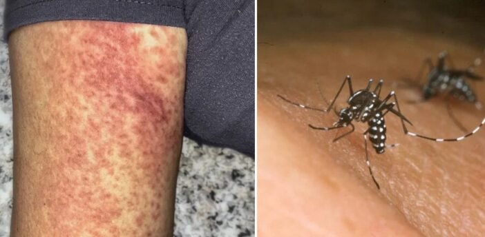 Több, mint duplájára emelkedett a chikungunya vírussal fertőzöttek száma az Egyesült Királyságban - amihez egy szúnyogcsípés is elég