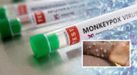 Közel triplájára nőtt a majomhimlővel fertőzöttek száma pár nap alatt Angliában 2
