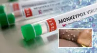 Közel triplájára nőtt a majomhimlővel fertőzöttek száma pár nap alatt Angliában
