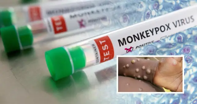 Közel triplájára nőtt a majomhimlővel fertőzöttek száma pár nap alatt Angliában 12