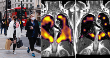 Sok Covidosnál, akik légszomjat tapasztalnak, tüdőrendellenességet fedeztek fel, miután átestek a betegségen