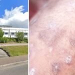 „Középkori” bőrbetegség terjed az angliai iskolákban Devonban – iskolabezárás, aggódó szülők és gyorsan terjedő fertőzés