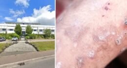 "Középkori" bőrbetegség terjed az angliai iskolákban Devonban – iskolabezárás, aggódó szülők és gyorsan terjedő fertőzés