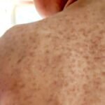 Gyorsan terjed a kanyarójárvány Londonban – egy kerületben már 80 gyerek fertőződött meg