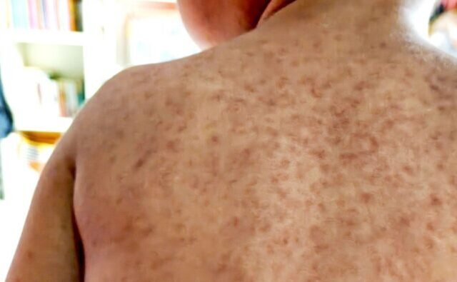 Gyorsan terjed a kanyarójárvány Londonban – egy kerületben már 80 gyerek fertőződött meg