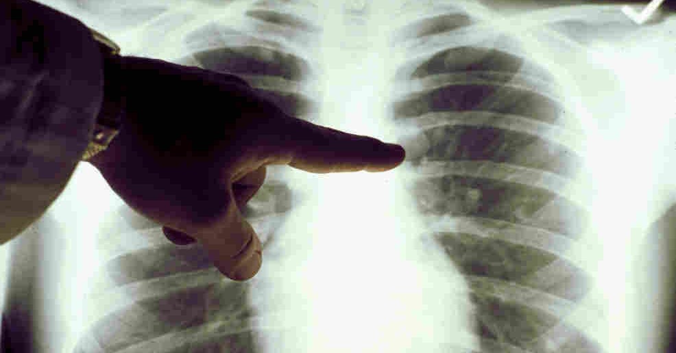 lungxray_wide-92a53bc229095c3a0b3f3d7ea700bded6b586728-s1100-c15