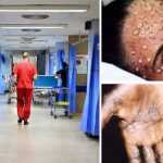 Pár nap alatt a második „majomhimlővel” fertőzött beteg került elő Angliában